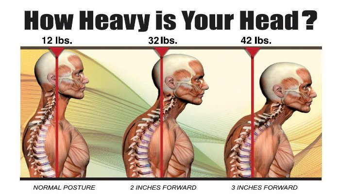 Forward Head Posture - Physiopedia